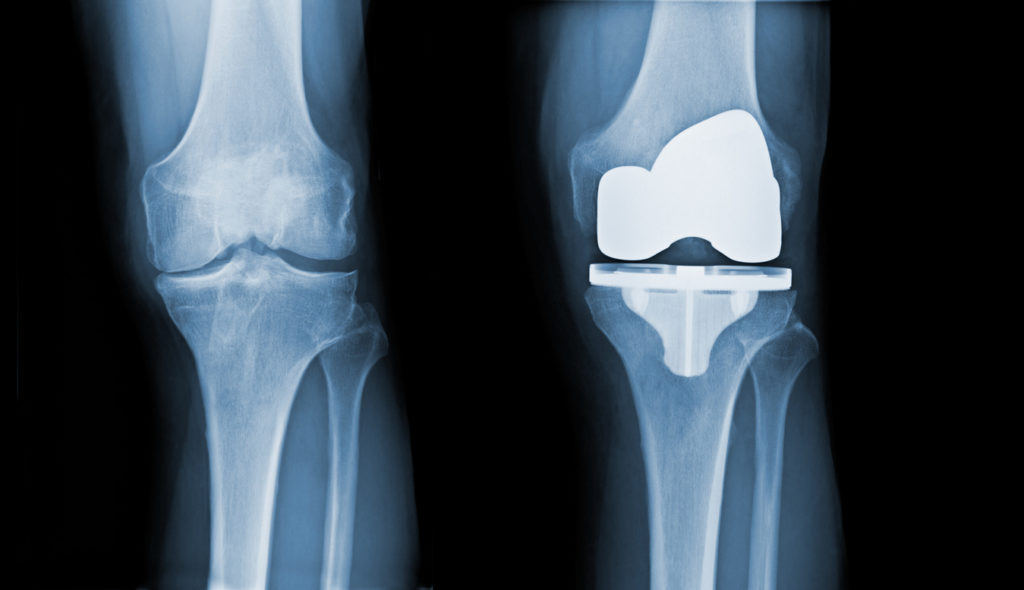 Total Knee Replacement3